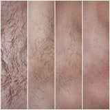 Auris Seréne IPL Hair Removal Device