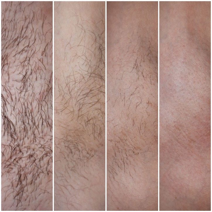 Auris Seréne IPL Hair Removal Device