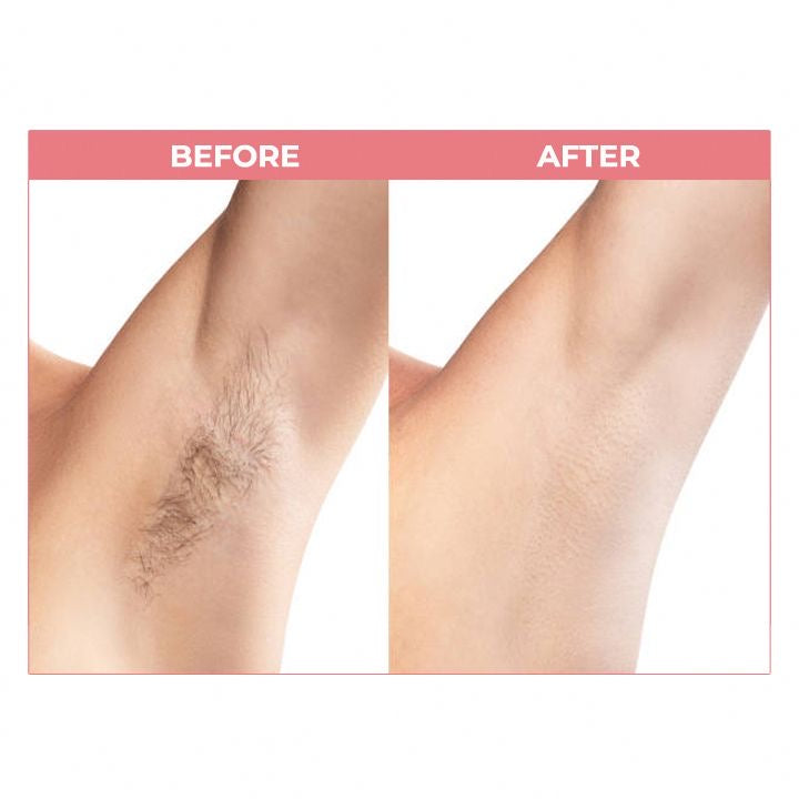 Auris Seréne IPL Hair Removal Device